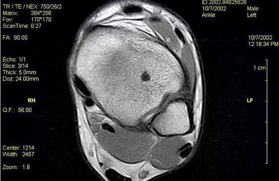 a mri scan of a normal knee