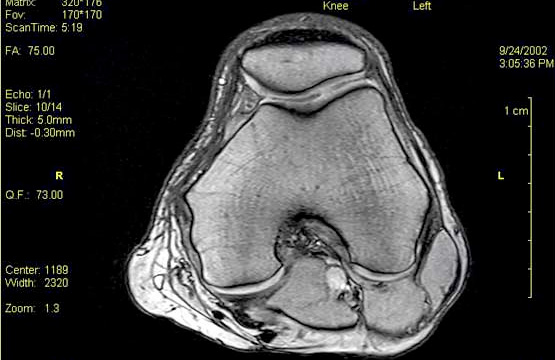 MRI Scan Knee - Patella tendon retropatcartilage Kne